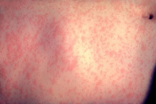 Measles rash