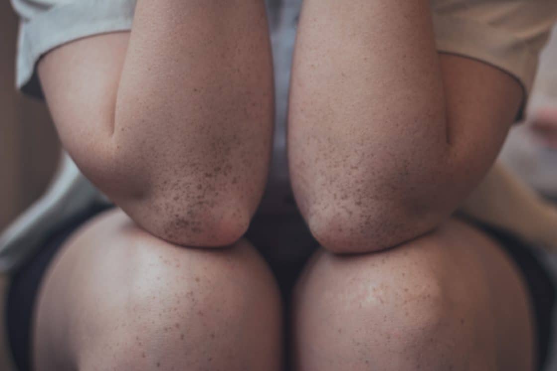 Photo of a woman's knees and elbows