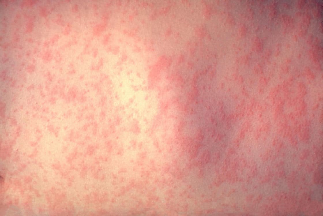 A seventh case of measles has been confirmed in Canterbury