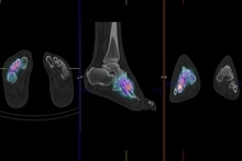 Bone Scan Feet WS.jpg