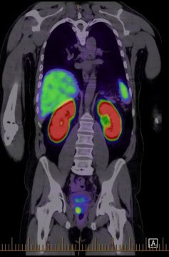 PSMA SCAN