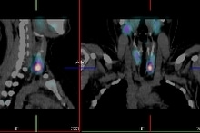 Parathyroid Scan +ve-001.jpg